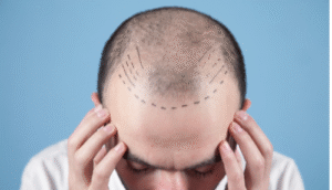 greffe capillaire
Clinique pour greffe de cheveux en Turquie 